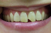 Chipped tooth