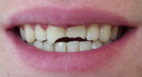 Chipped tooth
