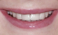 Fixed crowns