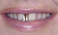 Crowns